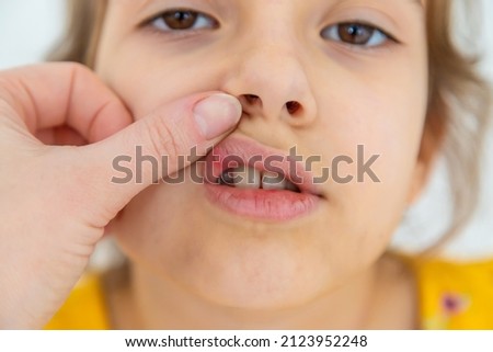 The child has stomatitis on the lip. Selective focus. Kid. Royalty-Free Stock Photo #2123952248