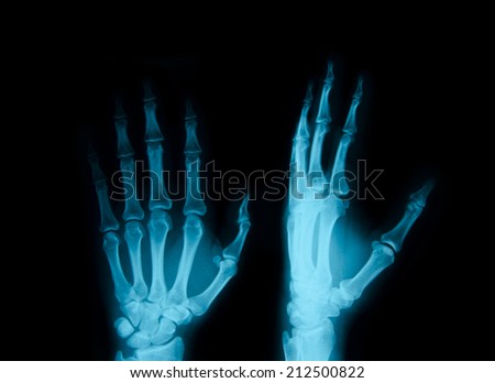 x-ray of hands on black background