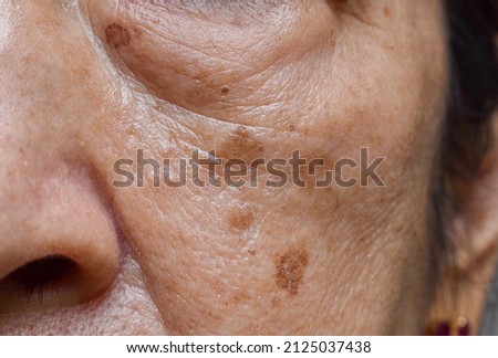 Small brown patches called age spots on face of Asian elder woman. They are also called liver spots, senile lentigo, or sun spots. Closeup view. Royalty-Free Stock Photo #2125037438