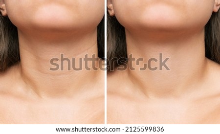 Сlose-up of young woman's neck with wrinkles before and after treatment. Result of cosmetic rejuvenating procedures. Lines, age-related changes, Venus rings. Neck lift, collagen injections, skin care Royalty-Free Stock Photo #2125599836