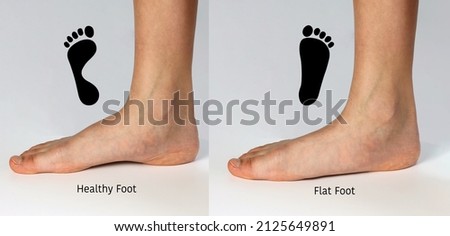 Normal neutral healthy foot compare with  flat foot or fallen arch problem with Foot print to show how entire sole of the foot to touch the floor when stand up. Royalty-Free Stock Photo #2125649891
