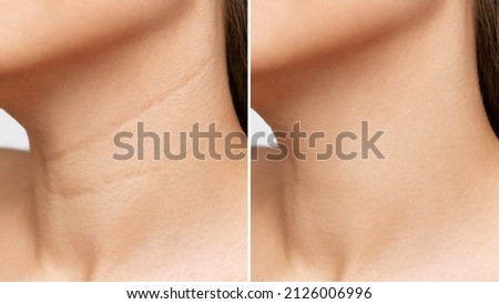 Сlose-up of young woman's neck with wrinkles before and after treatment. Result of cosmetic rejuvenating procedure. Lines, age-related changes, Venus rings.Neck lifting, collagen injections, skin care Royalty-Free Stock Photo #2126006996