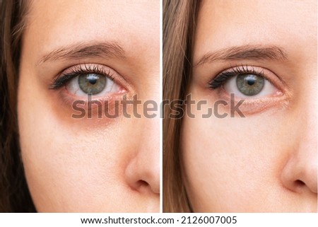 Cropped shot of a young caucasian woman's face with dark circles under eyes before and after cosmetic treatment. Bruises under the eyes caused by fatigue, insomnia. The result of therapy Royalty-Free Stock Photo #2126007005