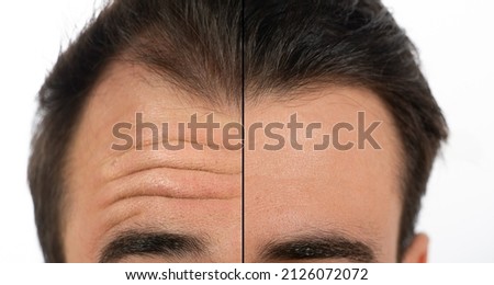 face of a man before and after a cosmetic treatment to smooth expression lines in forehead. Concept of anti-aging and rejuvenation cosmetics on forehead wrinkles Royalty-Free Stock Photo #2126072072