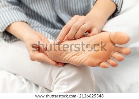 Dry cracked skin of feet and heels. Peeling, cracks and cornea sole of the foot. Dryness, dermatitis, dehydration, eczema, psoriasis, skincare and health concept. Royalty-Free Stock Photo #2126625548