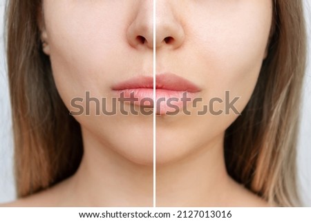 Result of lip augmentation. Cropped shot of young blonde woman's face with lips before and after lip enhancement on a gray background. Injection of filler in lips
