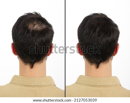 Head seen from behind showing the nape of a young man with calvization principle before and after anti-hair loss treatment. Concept of early hair loss Royalty-Free Stock Photo #2127053039