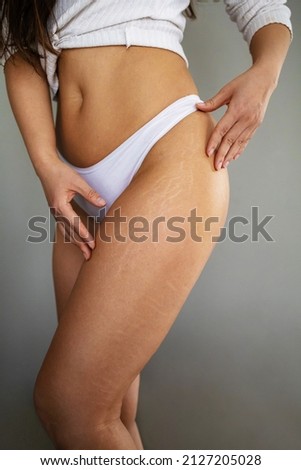 Stretch marks on female legs. A woman's hand holds a fat cellulite and a stretch mark on her leg. Cellulite. Royalty-Free Stock Photo #2127205028