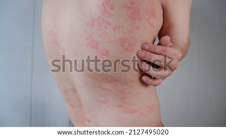 Close up image of skin texture suffering severe urticaria or hives or kaligata. Allergy symptoms. Royalty-Free Stock Photo #2127495020