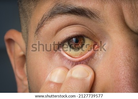 Sick man checking yellow eyes because of high bilirubin level, cirrhosis or hepatitis. Liver disease, liver problems or jaundice Royalty-Free Stock Photo #2127739577