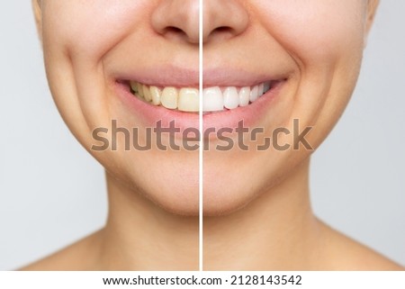 Cropped shot of a young smiling woman before and after teeth whitening isolated on a gray background. Dark tooth enamel, contrast. Dentistry, dental care Royalty-Free Stock Photo #2128143542