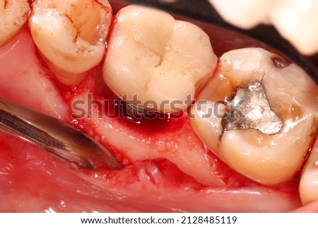 Peri-implantitis : Diseases that cause loss of bone around the dental implant, we can see the screw expose and gingival recession Royalty-Free Stock Photo #2128485119
