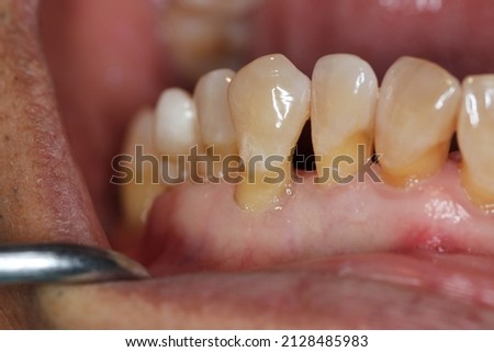 Gingival recession, also known as receding gums, is the exposure in the roots of the teeth caused by a loss of gum tissue and retraction of the gingival margin from the crown of the teeth. Royalty-Free Stock Photo #2128485983