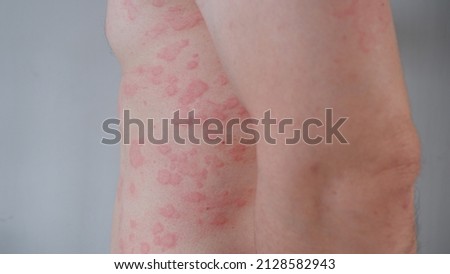 Close up image of skin texture suffering severe urticaria or hives or kaligata. Allergy symptoms. Royalty-Free Stock Photo #2128582943
