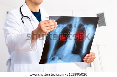 Lung Cancer or Pneumonia. Doctor check up x-ray image have problem lung tumor of patient or long covid at hospital Royalty-Free Stock Photo #2128995020