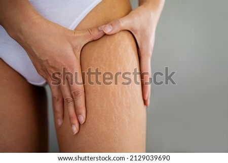 Stretch marks on female legs. A woman's hand holds a fat cellulite and a stretch mark on her leg. Cellulite. Royalty-Free Stock Photo #2129039690