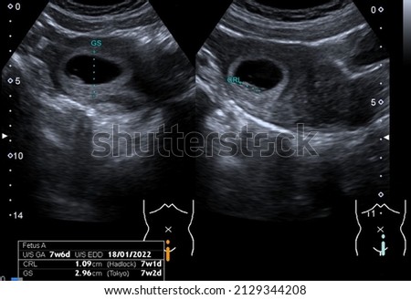 Ultrasound scan of a 7-week old foetus displaying the gestasional sac and a small fetus
 Royalty-Free Stock Photo #2129344208