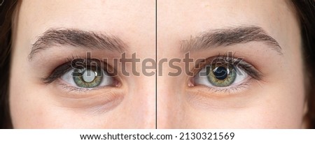 Macro of the eye of a young woman with and without cataracts. Simulation of before and after cataract removal surgery to avoid blindness Royalty-Free Stock Photo #2130321569