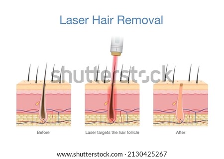 Laser hair removal at the skin layer and follicle for beauty and smoothness. Medical diagram before and after use laser get rid hair. Royalty-Free Stock Photo #2130425267