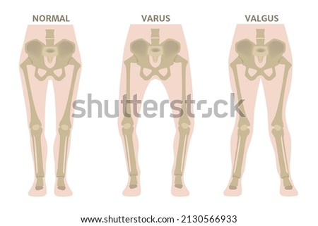 Valgus and varus leg deformities. Diagram showing the deformed bones of the lower extremities. Cosmetic pathology. Vector illustration. Royalty-Free Stock Photo #2130566933