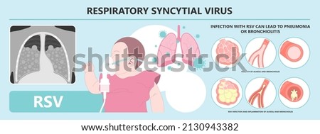 RSV virus covid 19 common cold flu human baby child viral Care Runny nose Cough Sneezing Fever Wheezing mask ventilator COPD tract kids sound NICU Unit croup treatment antigen rapid test Kit ATK Royalty-Free Stock Photo #2130943382