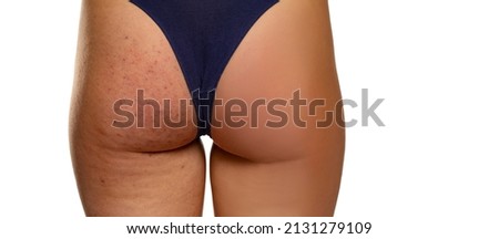 Female buttocks before and after treatment on white background Royalty-Free Stock Photo #2131279109