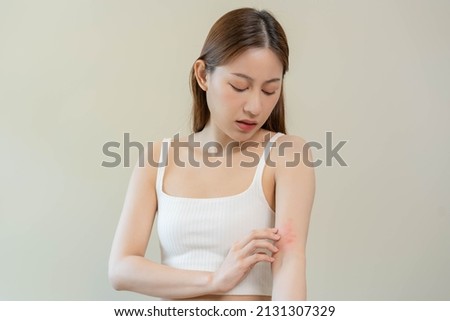 Dermatology, asian young woman looking on her arm allergy, allergic reaction from atopic, insect bites, hand in scratching itchy, itch red spot or rash of skin. Beauty problem by medical treatment. Royalty-Free Stock Photo #2131307329