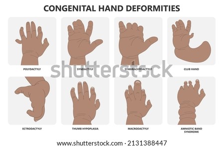 Hand finger gene prader willi band autism surgery baby simple thumb Apert minor born toes feet fused club hand Cleft Birth Ulnar multiple leg clubfoot child claw aplasia wrist forearm deformity extra Royalty-Free Stock Photo #2131388447
