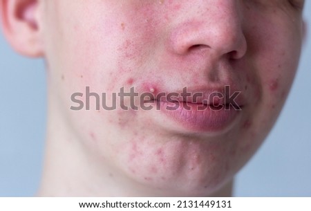 A picture of acne on the face of a teenager . Pimples, red scars and black dots on cheeks and chin. The concept of problem skin, care and beauty.