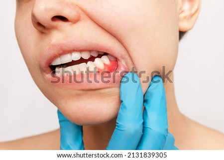 Gum inflammation. Cropped shot of a young woman's face with doctor's gloved hand on her jaw showing red bleeding gums isolated on a white background. Examination at the dentist. Dentistry, dental care