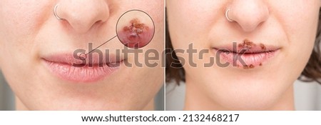 Closeup of female lips with pustules and crusts of Herpes Simplex. Macro with magnifying circle that highlights the labial fever in detail Royalty-Free Stock Photo #2132468217