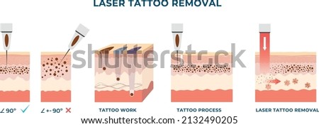 Laser tattoo removal process. Anatomical epidermis side view with pigment under skin. Vector illustration.  Royalty-Free Stock Photo #2132490205