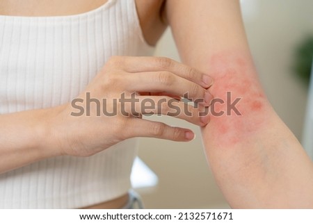Dermatology, asian young woman, girl hand in her arm allergy, allergic reaction from atopic, insect bites, hand in scratching itchy, itch red spot or rash of skin. Beauty problem by medical treatment. Royalty-Free Stock Photo #2132571671