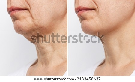 Lower part of the face and neck of elderly woman with signs of skin aging before and after facelift, plastic surgery on white background. Age-related changes, flabby sagging skin, wrinkles, creases Royalty-Free Stock Photo #2133458637