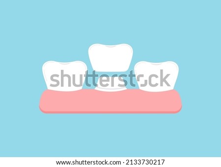 Tooth with crown in gum dental vector sign isolated. Teeth aestetic prosthesis treatment icon. Flat design cartoon style vector dental health clip art illustration.