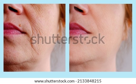 close-up part of female face of woman 40-50 years old with age wrinkles, facial wrinkles before and after treatment, concept of cosmetics, skincare, correction surgery, flyer for your ad antiaging Royalty-Free Stock Photo #2133848215