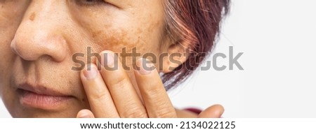 Menopausal women worry about melasma on face. Royalty-Free Stock Photo #2134022125