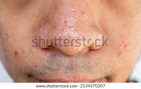 Close up of pores and pimples on men's nose. Nose pores are openings into the skin, where sebaceous glands produce and distribute the skin's natural oil. Royalty-Free Stock Photo #2134370207