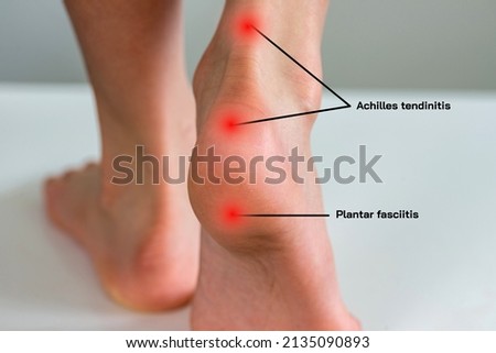 Close up human heel with red spots  point at pain in Achilles tendon in the back of the heel or heel pain in runner. Foot disease chart use for medical concept. Royalty-Free Stock Photo #2135090893