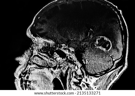 CAT SCAN with brain toxoplasmosis. Multiples brain tumors with ring enhancing lesion and perilesional edema. Located in mesencephalon and thalamus white matter, cortical and subcortical area. Royalty-Free Stock Photo #2135133271