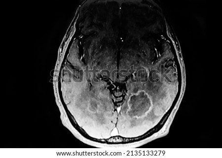 CAT SCAN with brain toxoplasmosis. Multiples brain tumors with ring enhancing lesion and perilesional edema. Located in mesencephalon and thalamus white matter, cortical and subcortical area. Royalty-Free Stock Photo #2135133279