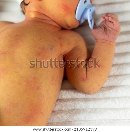 yellowish neonatal jaundice of the skin occurs in newborns in the first days of birth Royalty-Free Stock Photo #2135912399