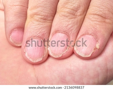 Hand of a 9 year old boy showing his brittle fingernails, nail disease, extreme close up Royalty-Free Stock Photo #2136098837