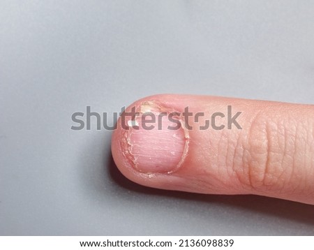 Fingernail of a 9 year old boy with a nail disease, very weak or brittle nails, isolated on gray background, with copy space Royalty-Free Stock Photo #2136098839