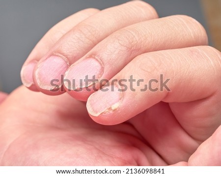 Hand of a child with weak or brittle fingernails, isolated on gray background, no faces are shown , close up look Royalty-Free Stock Photo #2136098841