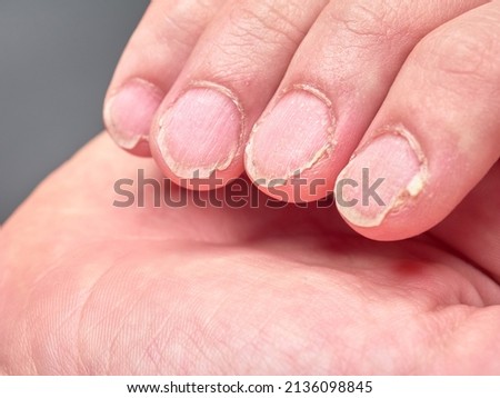 Hand of a 9 year old boy showing his fingernails with brittle or very weak nails, close up look Royalty-Free Stock Photo #2136098845