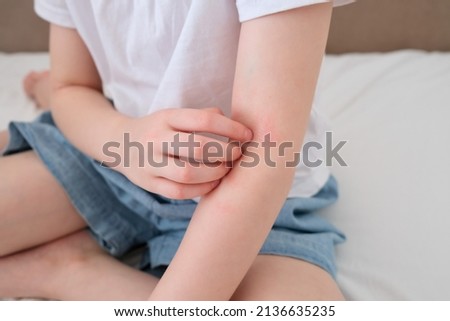 Atopic dermatitis on the bends of the child's arms.Dermatitis, psoriasis, allergy, atopy. Selective focus Royalty-Free Stock Photo #2136635235