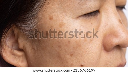 Menopausal women worry about melasma on face. Royalty-Free Stock Photo #2136766199