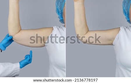 Before and after. Brachioplasty. Plastic arms, dangling skin at the elbow. An older woman shows the surgeon problem areas of the forearm. Examination before cosmetic surgery Royalty-Free Stock Photo #2136778197