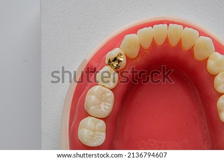 gold inlay setting in dentiform Royalty-Free Stock Photo #2136794607